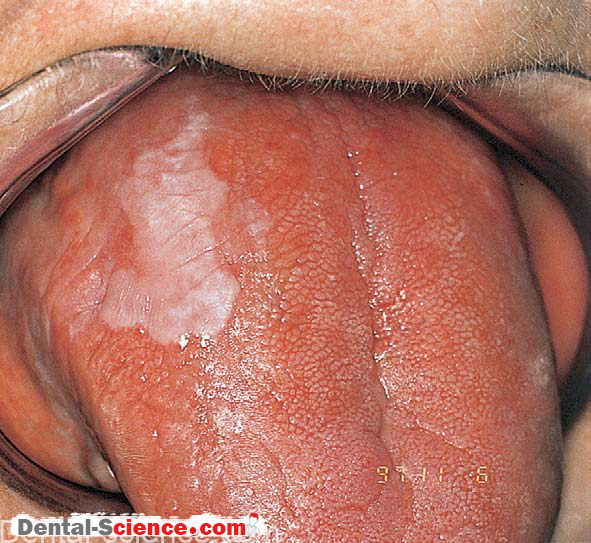 White Oral Lesion 51