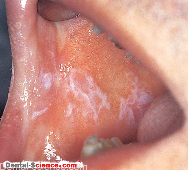 White Lesion In Mouth 34