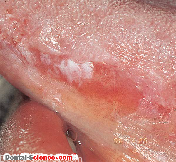 These are usually restricted to one area (e.g. the edge of the tongue, one of the buccal mucosa, the anterior floor of the mouth), and they are made of single white plaques, although often multiple, surrounded by red spots.