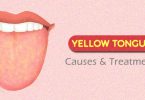 Yellow Tongue Causes & Treatment